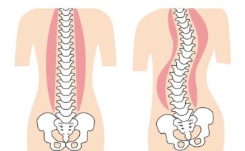 Cerca de 6 milhões de brasileiros sofrem com a escoliose