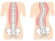 Cerca de 6 milhões de brasileiros sofrem com a escoliose